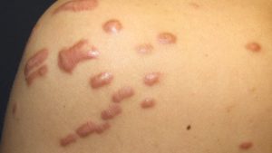 Keloid