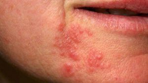 Perioral Dermatit (Ağız Etrafı Sivilceleri)